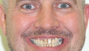 Before - Natural Smiles Implant & Cosmetic Dentistry