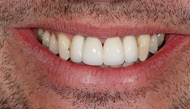 After - Natural Smiles Implant & Cosmetic Dentistry