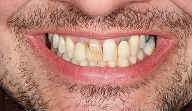 Before - Natural Smiles Implant & Cosmetic Dentistry
