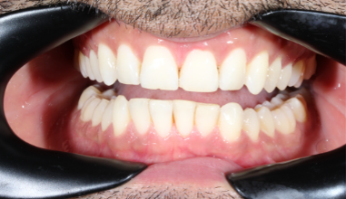 After - Natural Smiles Implant & Cosmetic Dentistry