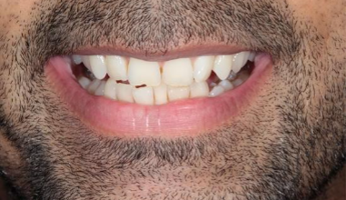 Before - Natural Smiles Implant & Cosmetic Dentistry