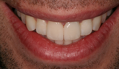 After - Natural Smiles Implant & Cosmetic Dentistry