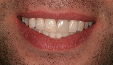 Before - Natural Smiles Implant & Cosmetic Dentistry