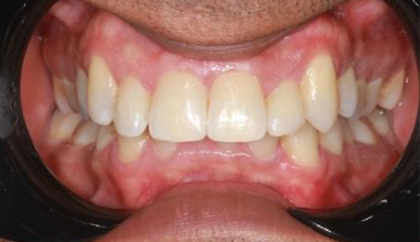 After - Natural Smiles Implant & Cosmetic Dentistry