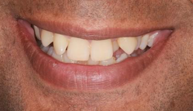 Before - Natural Smiles Implant & Cosmetic Dentistry