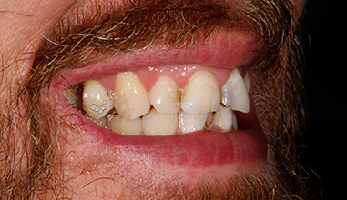 Before - Natural Smiles Implant & Cosmetic Dentistry