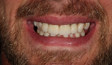 After - Natural Smiles Implant & Cosmetic Dentistry