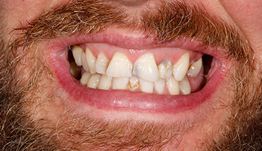Before - Natural Smiles Implant & Cosmetic Dentistry