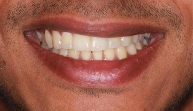 After - Natural Smiles Implant & Cosmetic Dentistry