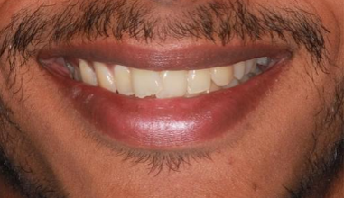 Before - Natural Smiles Implant & Cosmetic Dentistry