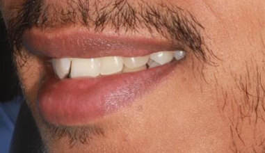 Before - Natural Smiles Implant & Cosmetic Dentistry