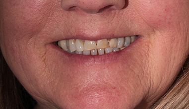 Before - Natural Smiles Implant & Cosmetic Dentistry