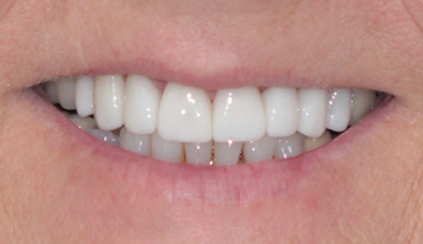 After - Natural Smiles Implant & Cosmetic Dentistry