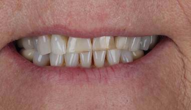 Before - Natural Smiles Implant & Cosmetic Dentistry