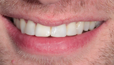 After - Natural Smiles Implant & Cosmetic Dentistry