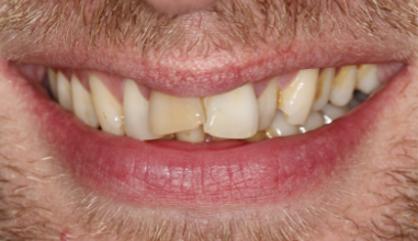 Before - Natural Smiles Implant & Cosmetic Dentistry
