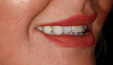 Before - Natural Smiles Implant & Cosmetic Dentistry