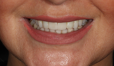 After - Natural Smiles Implant & Cosmetic Dentistry