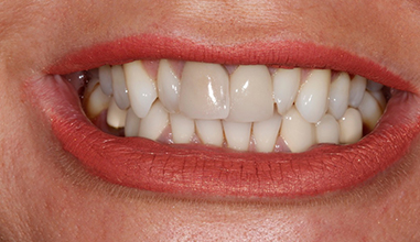 Before - Natural Smiles Implant & Cosmetic Dentistry