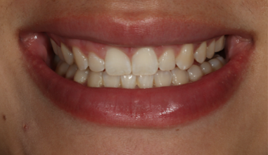 After - Natural Smiles Implant & Cosmetic Dentistry