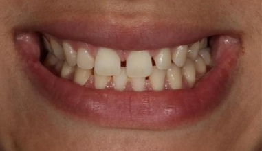 Before - Natural Smiles Implant & Cosmetic Dentistry