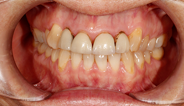 Before - Natural Smiles Implant & Cosmetic Dentistry