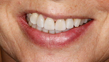 After - Natural Smiles Implant & Cosmetic Dentistry