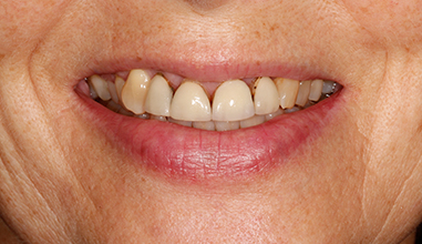 Before - Natural Smiles Implant & Cosmetic Dentistry