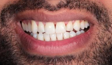 After - Natural Smiles Implant & Cosmetic Dentistry