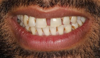 Before - Natural Smiles Implant & Cosmetic Dentistry