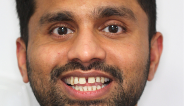 Before - Natural Smiles Implant & Cosmetic Dentistry