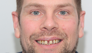 Before - Natural Smiles Implant & Cosmetic Dentistry