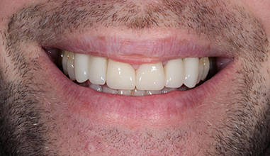 After - Natural Smiles Implant & Cosmetic Dentistry