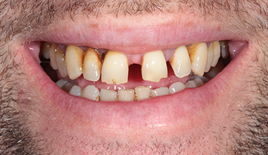 Before - Natural Smiles Implant & Cosmetic Dentistry