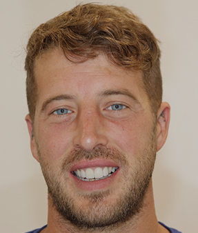 Treatment - Natural Smiles Implant & Cosmetic Dentistry